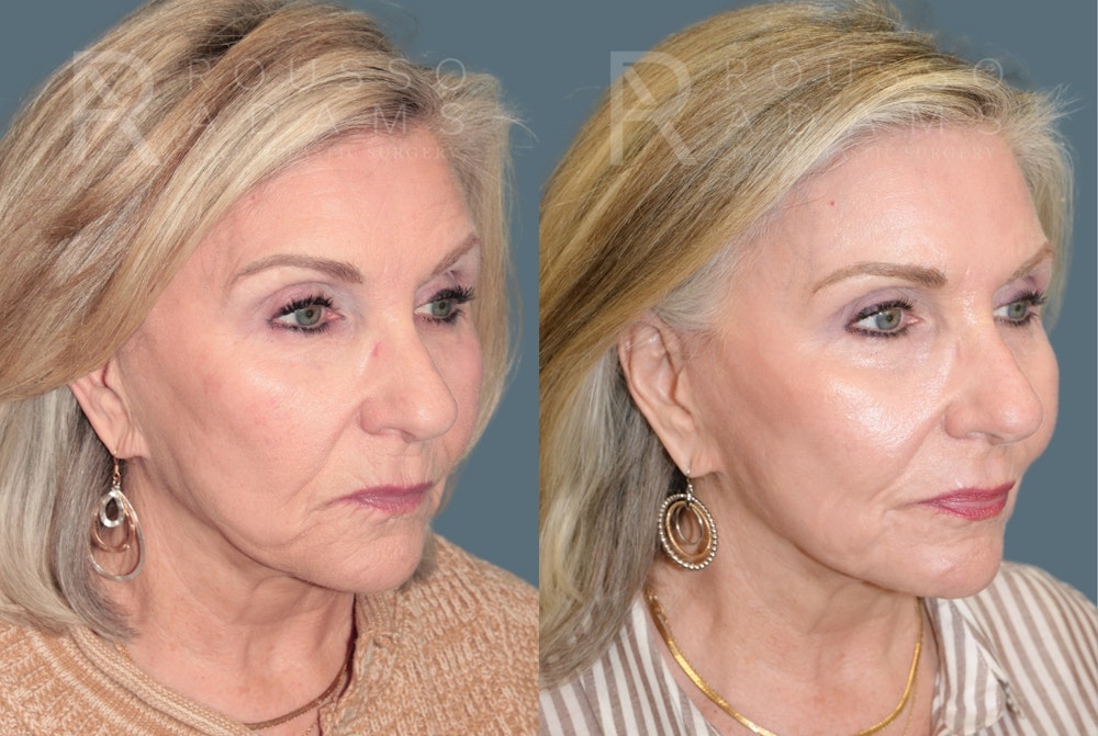 Deep Chemical Peel Gallery <span class=small>By Dr. Daniel Rousso</span> Before & After Gallery - Patient 203061 - Image 1