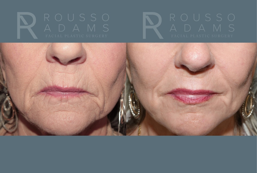 Deep Chemical Peel Gallery <span class=small>By Dr. Daniel Rousso</span> Before & After Gallery - Patient 203061 - Image 4