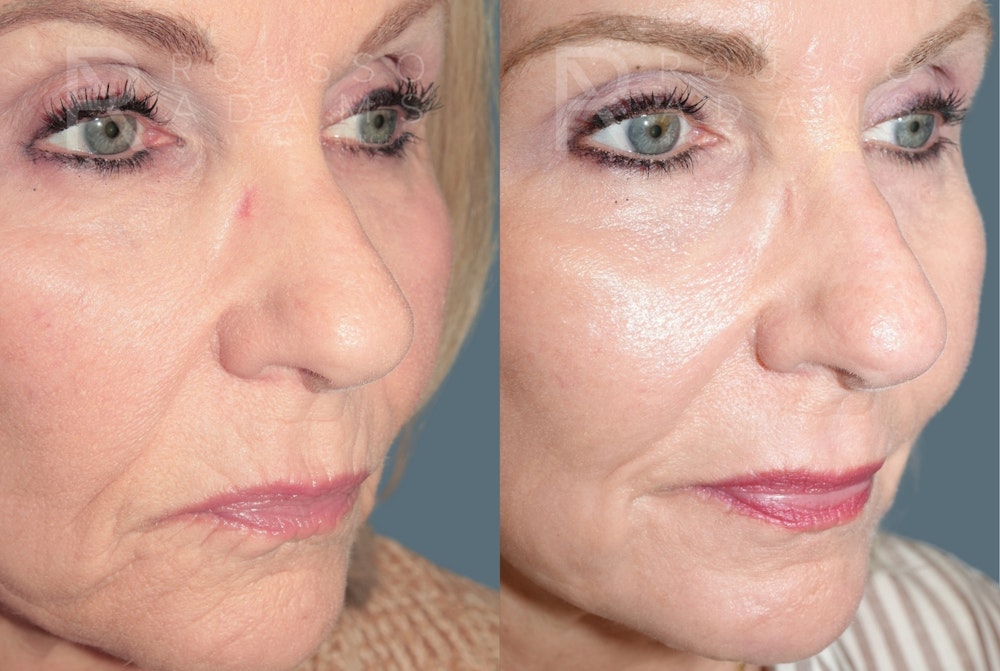 Deep Chemical Peel Gallery <span class=small>By Dr. Daniel Rousso</span> Before & After Gallery - Patient 203061 - Image 3