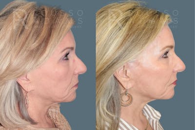 Deep Chemical Peel Gallery <span class=small>By Dr. Daniel Rousso</span> Before & After Gallery - Patient 203061 - Image 6