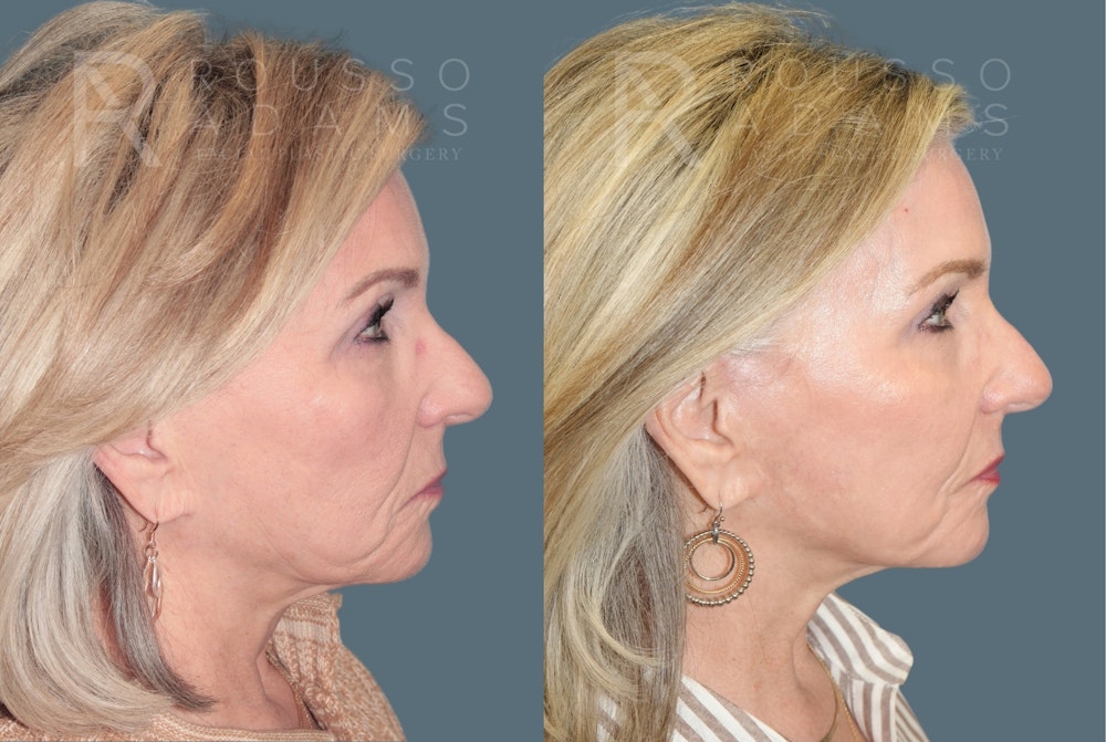 Deep Chemical Peel Gallery <span class=small>By Dr. Daniel Rousso</span> Before & After Gallery - Patient 203061 - Image 6