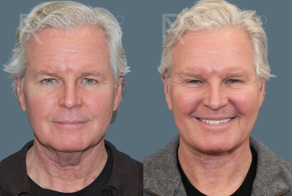 Male Facelift <span class=small>By Dr. Daniel Rousso</span> Before & After Gallery - Patient 417964 - Image 2