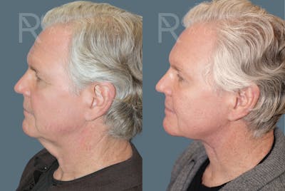 Male Facelift <span class=small>By Dr. Daniel Rousso</span> Before & After Gallery - Patient 417964 - Image 4