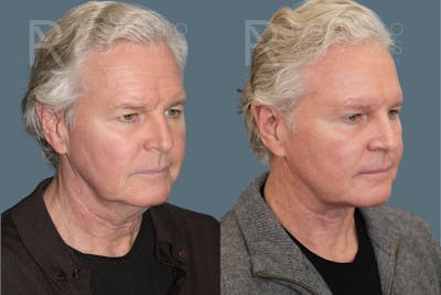 Male Facelift <span class=small>By Dr. Daniel Rousso</span> Before & After Gallery - Patient 417964 - Image 1