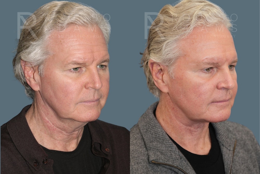 Male Facelift <span class=small>By Dr. Daniel Rousso</span> Before & After Gallery - Patient 417964 - Image 1