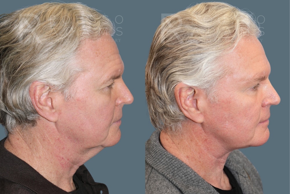Male Facelift <span class=small>By Dr. Daniel Rousso</span> Before & After Gallery - Patient 417964 - Image 3