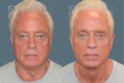 Male Facelift <span class=small>By Dr. Daniel Rousso</span> Before & After Gallery - Patient 384182 - Image 2