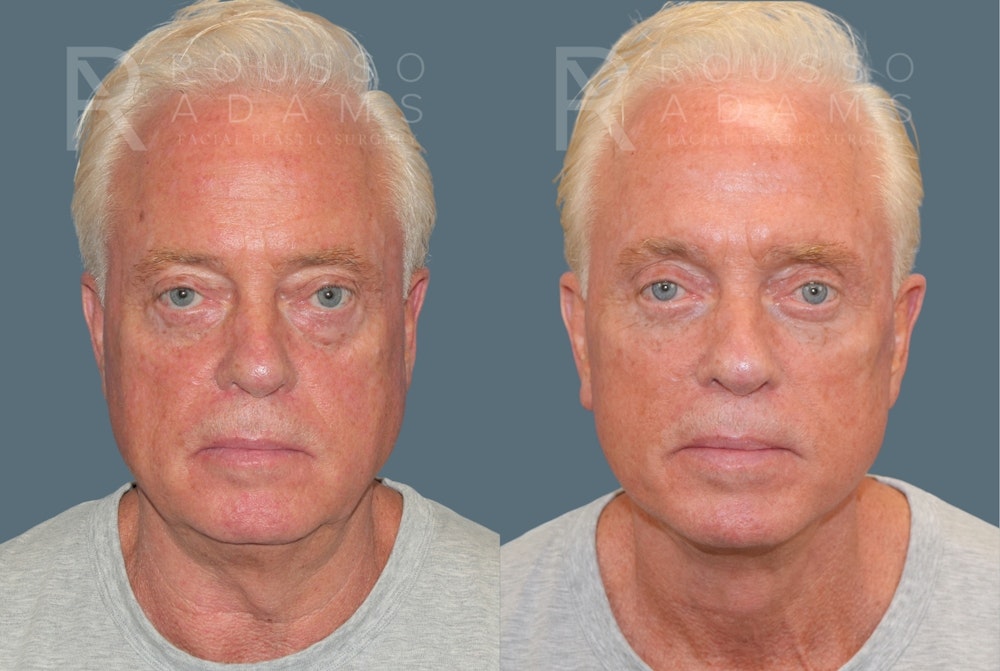 Male Facelift <span class=small>By Dr. Daniel Rousso</span> Before & After Gallery - Patient 384182 - Image 2
