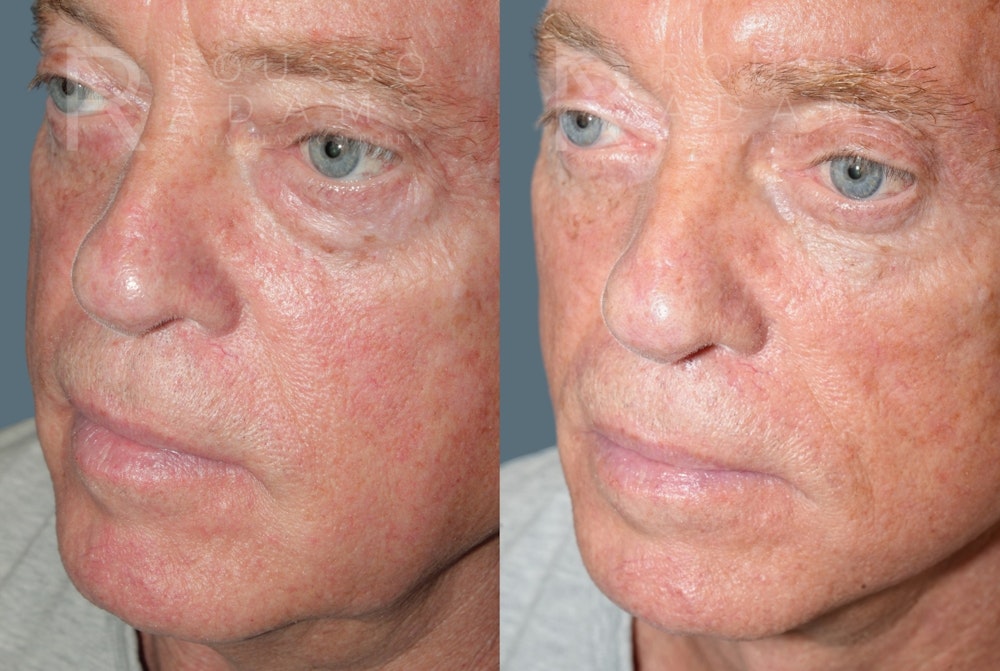 Male Facelift <span class=small>By Dr. Daniel Rousso</span> Before & After Gallery - Patient 384182 - Image 5