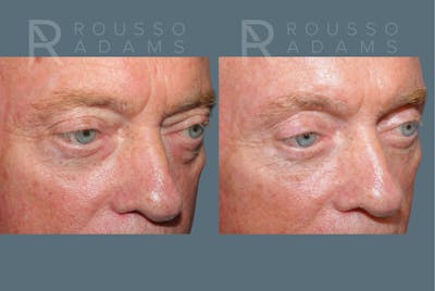 Male Facelift <span class=small>By Dr. Daniel Rousso</span> Before & After Gallery - Patient 384182 - Image 4
