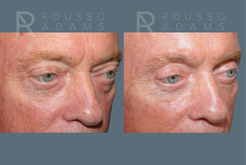 Male Facelift <span class=small>By Dr. Daniel Rousso</span> Before & After Gallery - Patient 384182 - Image 4