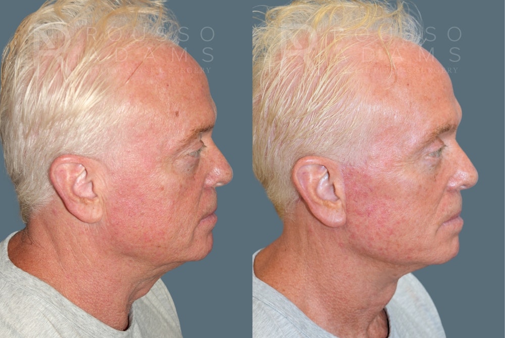 Male Facelift <span class=small>By Dr. Daniel Rousso</span> Before & After Gallery - Patient 384182 - Image 3