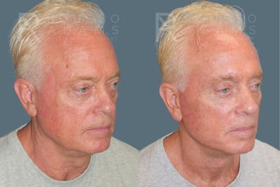 Male Facelift <span class=small>By Dr. Daniel Rousso</span> Before & After Gallery - Patient 384182 - Image 1