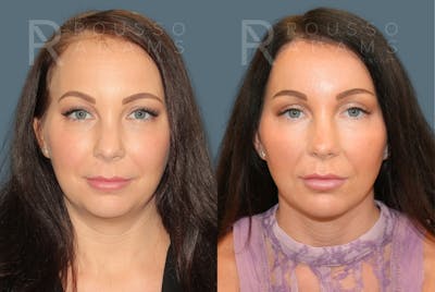 Acculift <span class=small>By Dr. Daniel Rousso</span> Before & After Gallery - Patient 300120 - Image 2