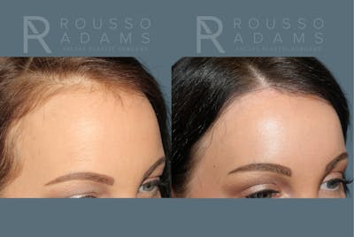 Acculift <span class=small>By Dr. Daniel Rousso</span> Before & After Gallery - Patient 300120 - Image 4