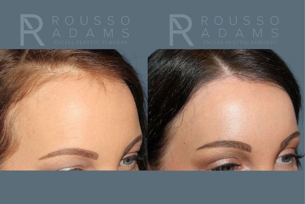 Acculift <span class=small>By Dr. Daniel Rousso</span> Before & After Gallery - Patient 300120 - Image 4