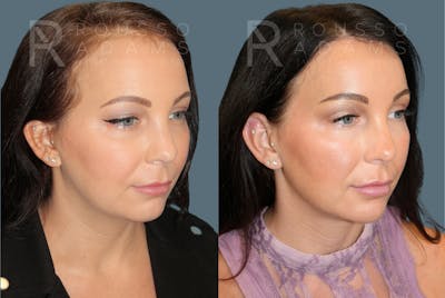 Acculift <span class=small>By Dr. Daniel Rousso</span> Before & After Gallery - Patient 300120 - Image 1