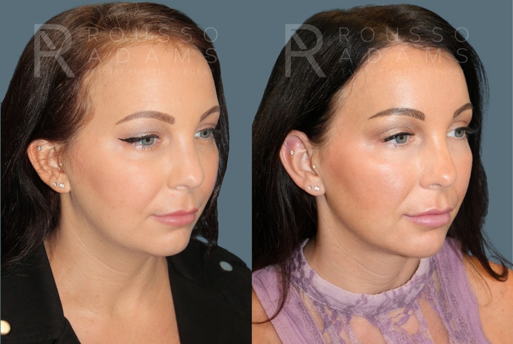 Acculift <span class=small>By Dr. Daniel Rousso</span> Before & After Gallery - Patient 300120 - Image 1