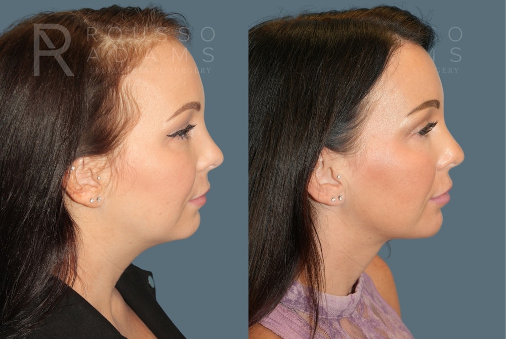 Acculift <span class=small>By Dr. Daniel Rousso</span> Before & After Gallery - Patient 300120 - Image 3