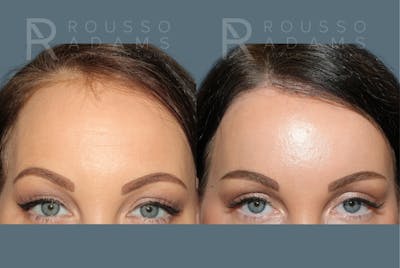 Hairline Advancement Before & After Gallery - Patient 158029 - Image 4