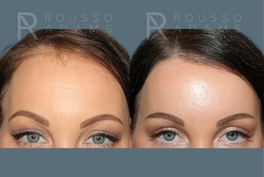 Acculift <span class=small>By Dr. Daniel Rousso</span> Before & After Gallery - Patient 300120 - Image 5