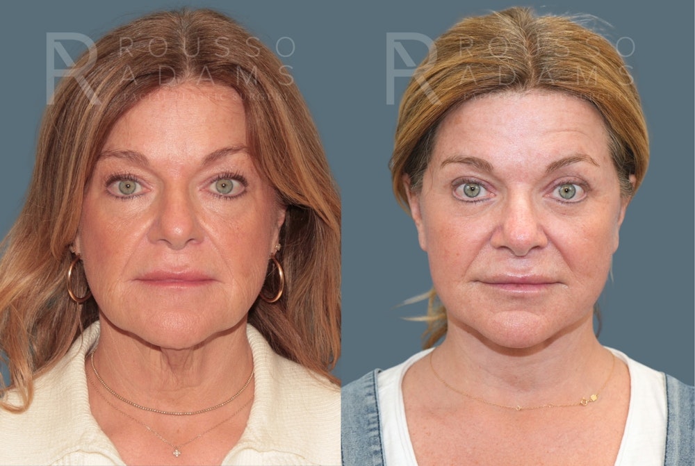 Deep Plane Facelift <span class=small>By Dr. Daniel Rousso</span> Before & After Gallery - Patient 148923 - Image 2