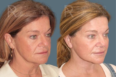 Deep Plane Facelift <span class=small>By Dr. Daniel Rousso</span> Before & After Gallery - Patient 148923 - Image 1