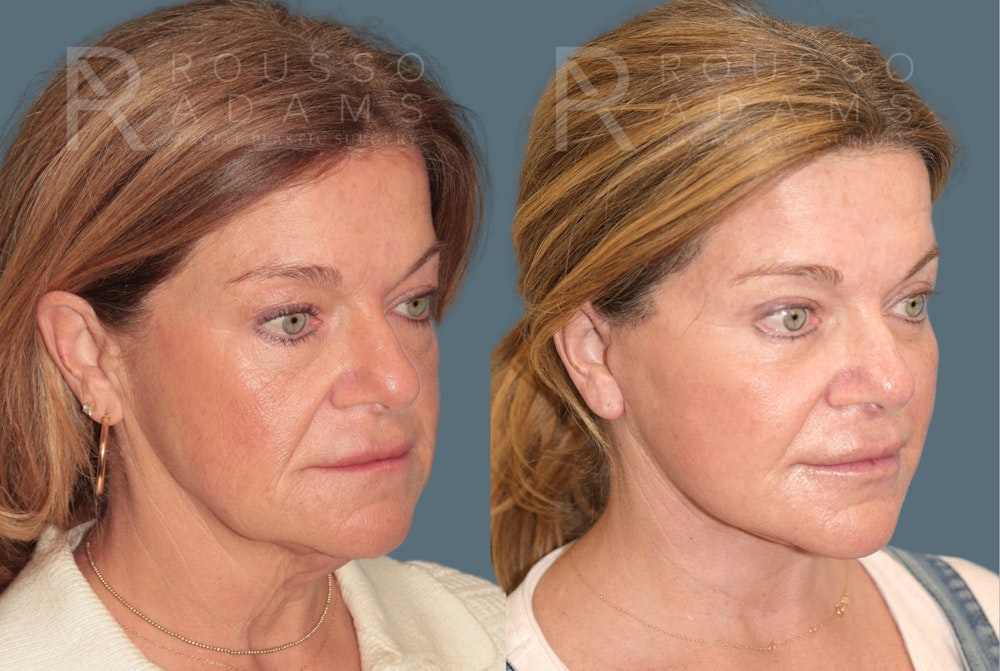 Deep Plane Facelift <span class=small>By Dr. Daniel Rousso</span> Before & After Gallery - Patient 148923 - Image 1