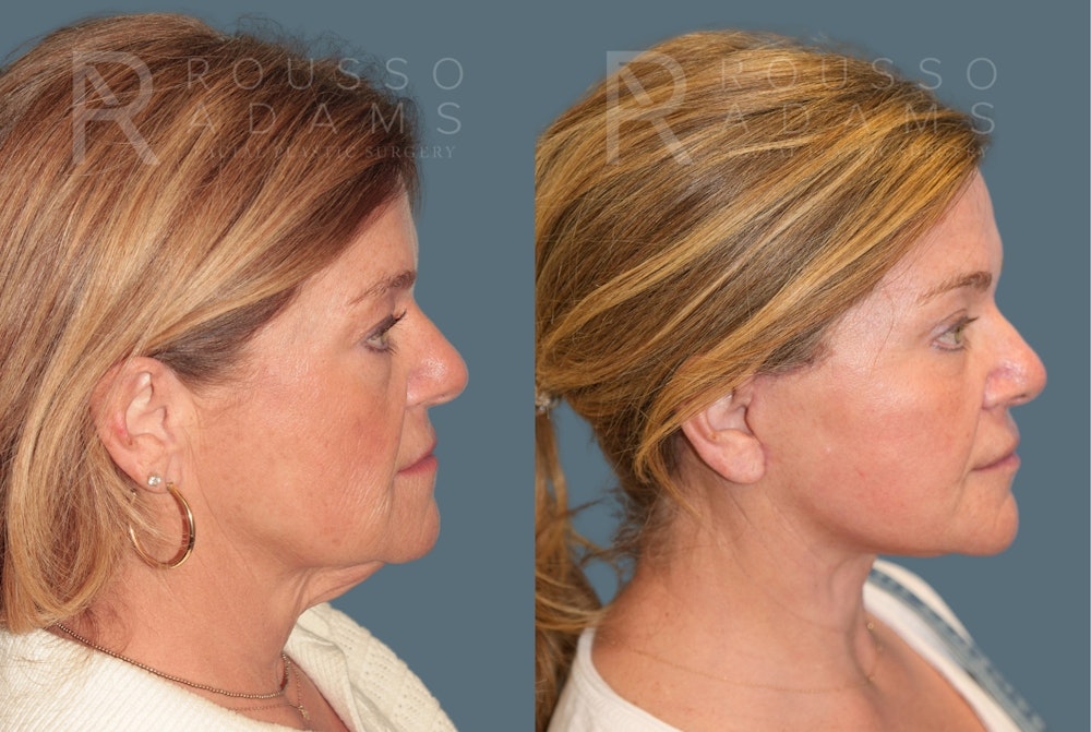 Deep Plane Facelift <span class=small>By Dr. Daniel Rousso</span> Before & After Gallery - Patient 148923 - Image 3
