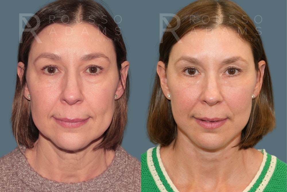 Deep Plane Facelift <span class=small>By Dr. Daniel Rousso</span> Before & After Gallery - Patient 267049 - Image 2
