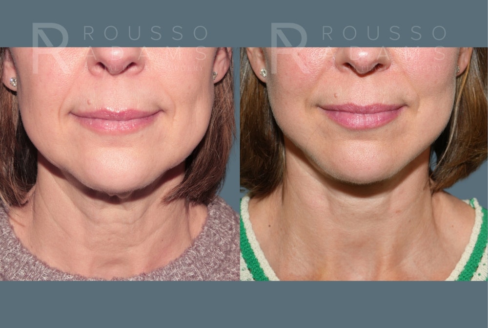 Deep Plane Facelift <span class=small>By Dr. Daniel Rousso</span> Before & After Gallery - Patient 267049 - Image 3