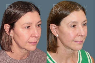 Deep Plane Facelift <span class=small>By Dr. Daniel Rousso</span> Before & After Gallery - Patient 267049 - Image 1