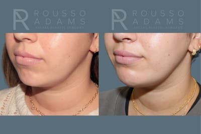 Facial Implants <span class=small>By Dr. Daniel Rousso</span> Before & After Gallery - Patient 140933 - Image 2