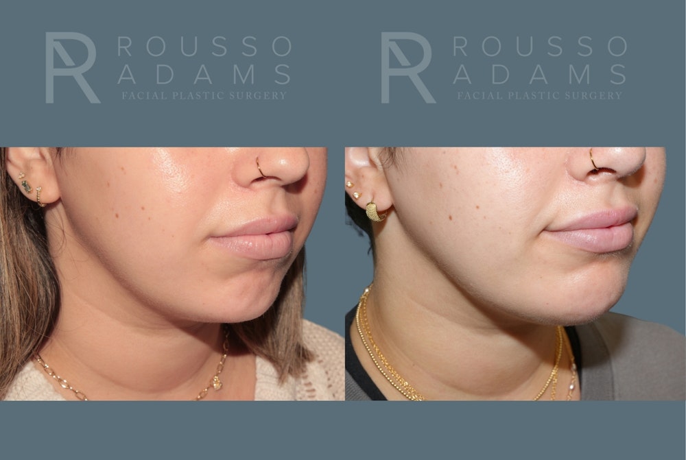Facial Implants <span class=small>By Dr. Daniel Rousso</span> Before & After Gallery - Patient 140933 - Image 3