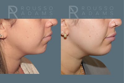 Facial Implants <span class=small>By Dr. Daniel Rousso</span> Before & After Gallery - Patient 140933 - Image 1