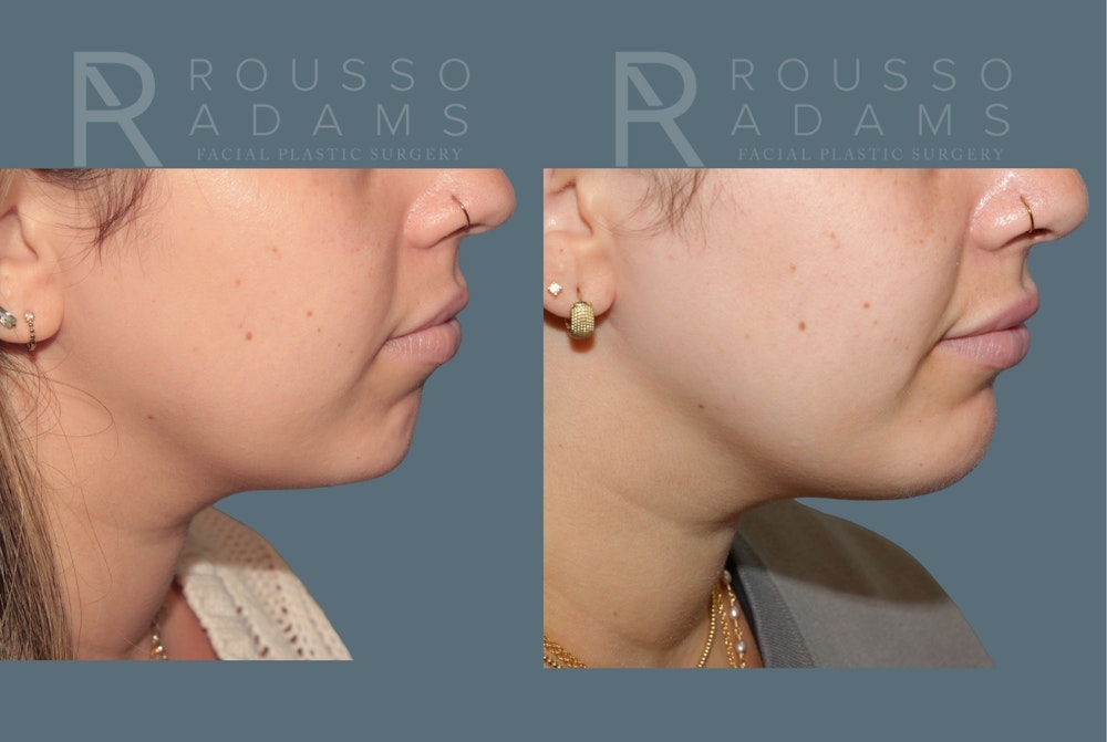 Facial Implants <span class=small>By Dr. Daniel Rousso</span> Before & After Gallery - Patient 140933 - Image 1