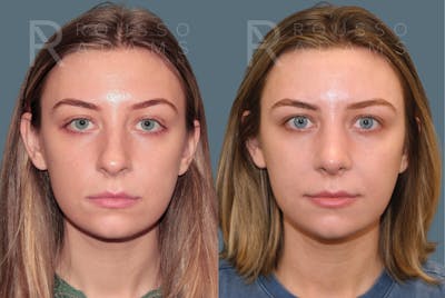 Rhinoplasty<span class=small>By Dr. Austin Adams</span> Before & After Gallery - Patient 385012 - Image 2