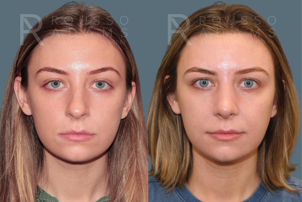 Rhinoplasty<span class=small>By Dr. Austin Adams</span> Before & After Gallery - Patient 385012 - Image 2