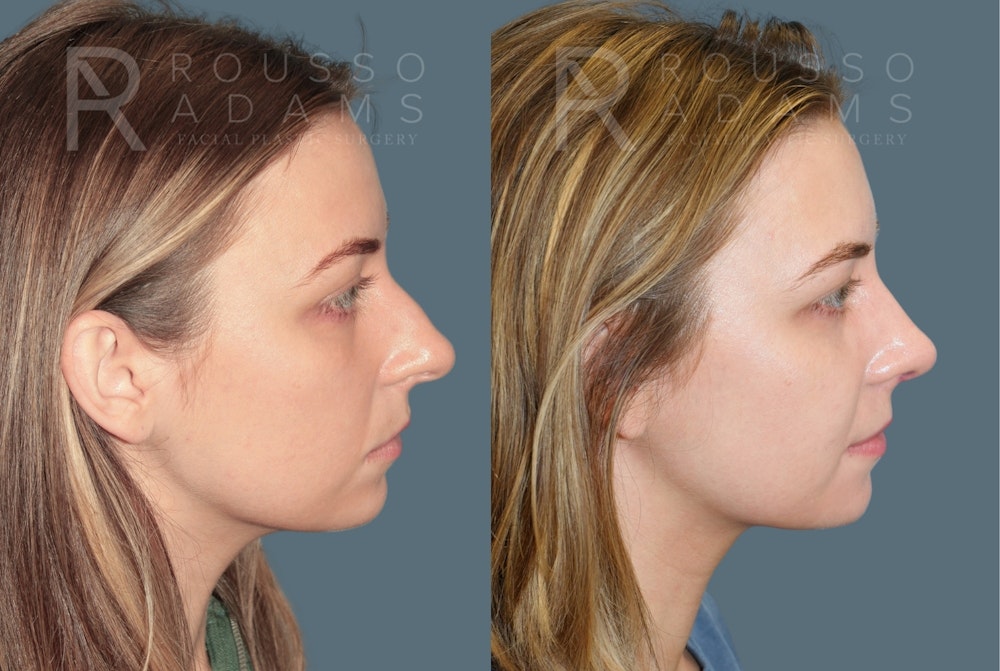 Rhinoplasty<span class=small>By Dr. Austin Adams</span> Before & After Gallery - Patient 385012 - Image 1
