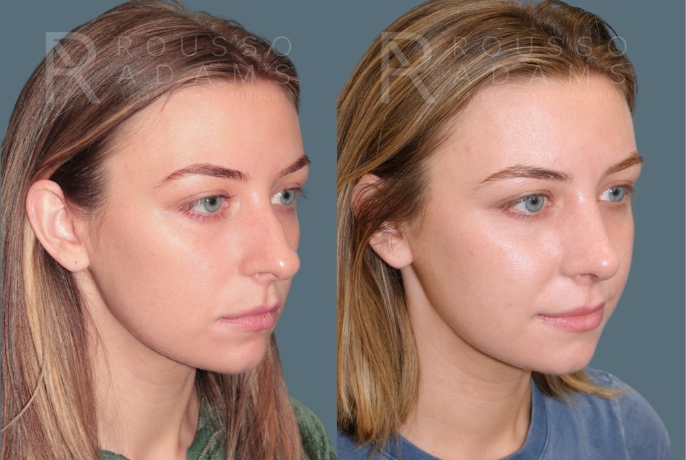 Rhinoplasty<span class=small>By Dr. Austin Adams</span> Before & After Gallery - Patient 385012 - Image 3