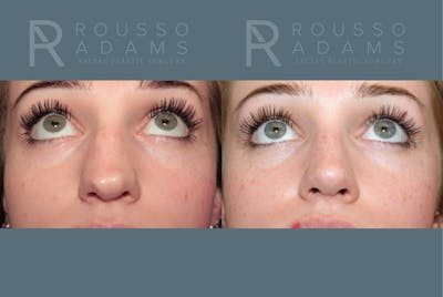 Revision Rhinoplasty<span class=small>By Dr. Austin Adams</span> Before & After Gallery - Patient 871913 - Image 4