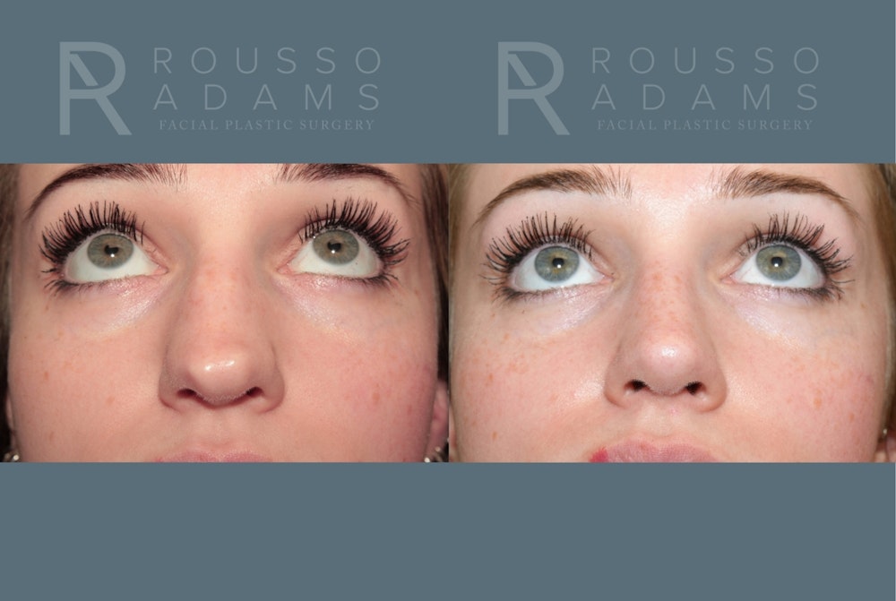 Revision Rhinoplasty<span class=small>By Dr. Austin Adams</span> Before & After Gallery - Patient 871913 - Image 4