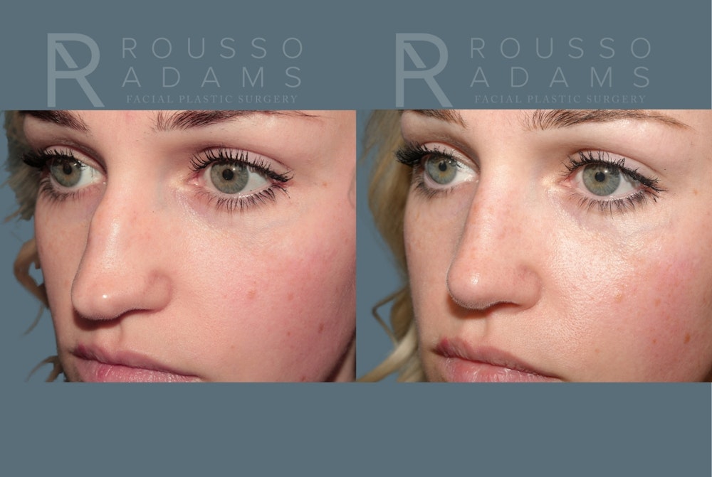 Revision Rhinoplasty<span class=small>By Dr. Austin Adams</span> Before & After Gallery - Patient 871913 - Image 3