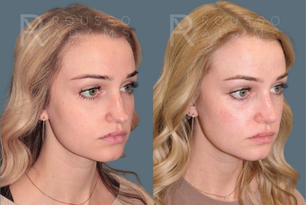 Revision Rhinoplasty<span class=small>By Dr. Austin Adams</span> Before & After Gallery - Patient 871913 - Image 2