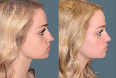 Revision Rhinoplasty<span class=small>By Dr. Austin Adams</span> Before & After Gallery - Patient 871913 - Image 1