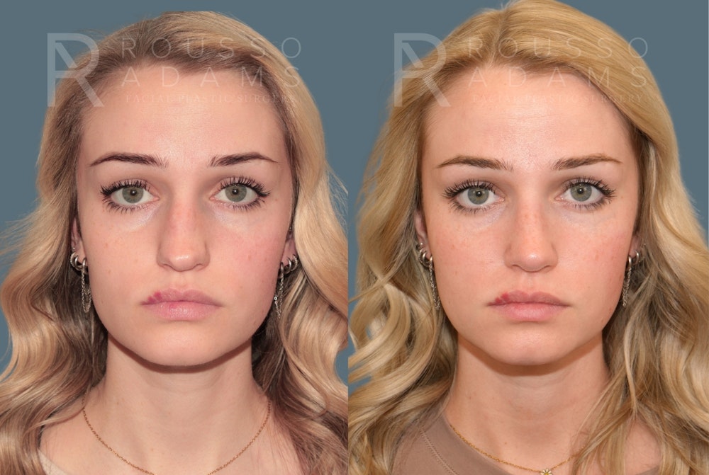 Revision Rhinoplasty<span class=small>By Dr. Austin Adams</span> Before & After Gallery - Patient 871913 - Image 5