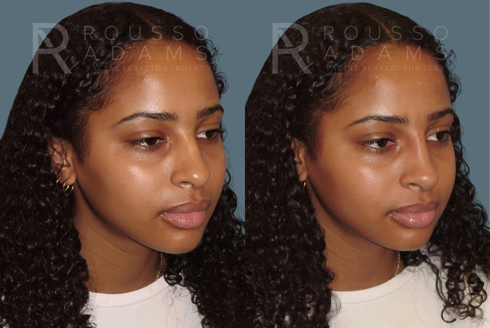 Liquid Rhinoplasty Gallery Before & After Gallery - Patient 354012 - Image 3