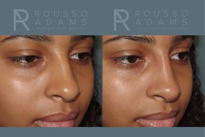 Liquid Rhinoplasty Gallery Before & After Gallery - Patient 354012 - Image 4