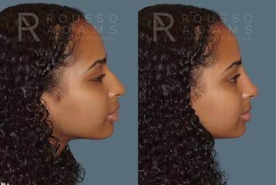 Liquid Rhinoplasty Gallery Before & After Gallery - Patient 354012 - Image 2