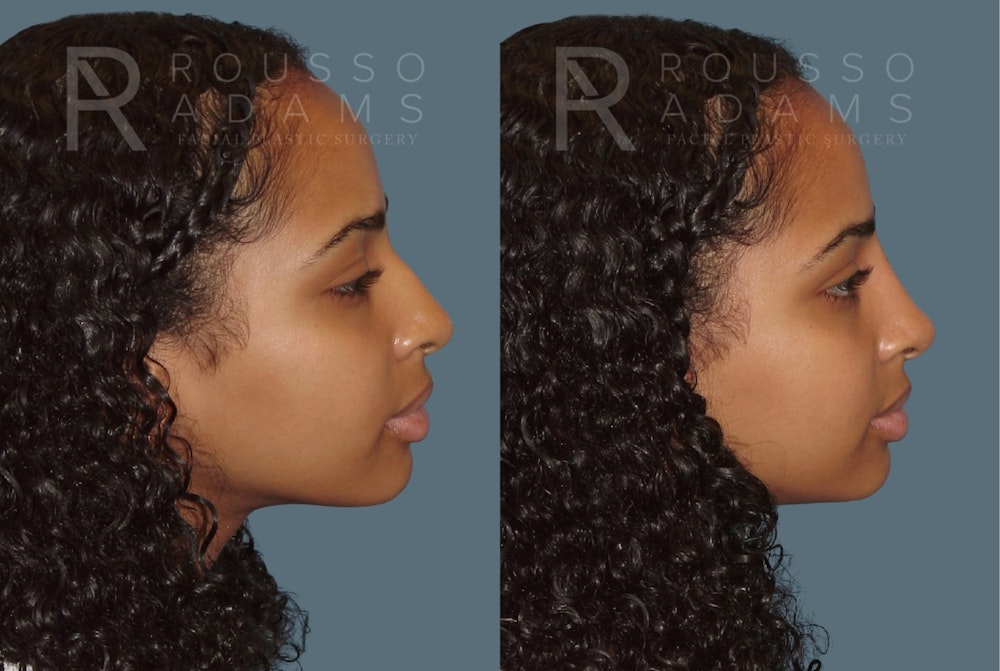Liquid Rhinoplasty Gallery Before & After Gallery - Patient 354012 - Image 2